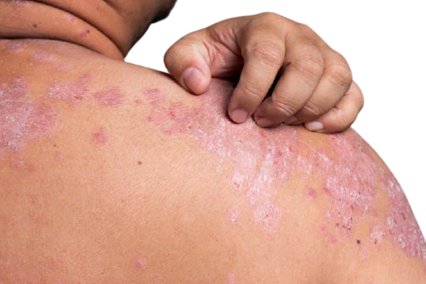 Seborrheic Dermatitis Raleigh Nc